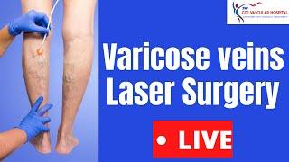 Varicose veins | Varicose veins laser Surgery Video in India By Varicose Expert