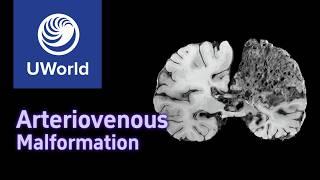 Cerebral Arteriovenous Malformation & Spontaneous Intracerebral Hemorrhage - USMLE STEP 1, UWorld