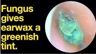 Fungus gives earwax a greenish tint. |ear wax removal | ear cleaning | ASMR | relaxation | relax