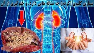 بیماری کلیوی و یا (گرده) چه نشانه هایی دارد. علائم بیماری کلیوی را بشناسید.