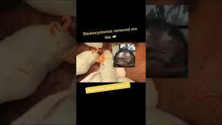 Butter Steatocystoma Squeezes  | Dr. Pimple Popper #drpimplepopper #shorts #pimplepopling