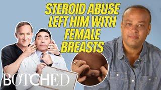 Guillermo's Steroid Addiction Left Him With Excess Breast Tissue Loose Skin | Botched | E!