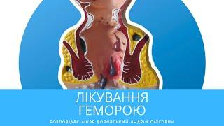Лікування геморою