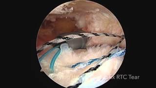 Copy of Rotator Cuff Tear and Arthroscopic Repair by Dr. Tony Moya