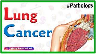 Lung Cancer / Pathology  - Squamous cell carcinoma #usmle #neetpg #fmge #mbbs