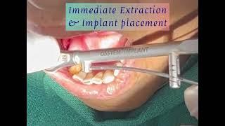 Immediate extraction and implant placement