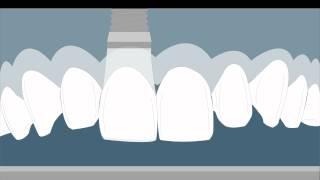 Implant Abutment and Crown Contour: Critical Contour and Subcritical Contour- Su 2010