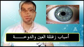 اسباب زغللة العين والدوخة ضياء تيوب   Diyaa Tube