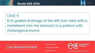 Livedemo | Nordic EUS 2018 | EUS guided drainage of the left liver