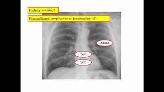 12DaysinMarch, Pulmonary Neoplasm for USMLE Step One