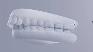 Carriere Motion 3D Class II & Aligners: Doctors Education