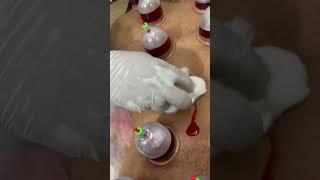 Kzhijama & leech therapy centre #kzhijama #hijama #cupping #cup #drkazi #leechtherapy #bharat #india