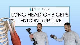 Long Head Biceps Tendon Rupture | Expert Physio Review