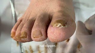 Healing Yellow Toenail: A Step-by-Step Journey