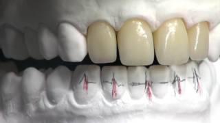 Veneering of Lithium Disilicate by Stefano Lombardo and Diego Foletto