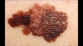 კანის კიბოს ამსახველი ფოტოები - Skin cancer pictures