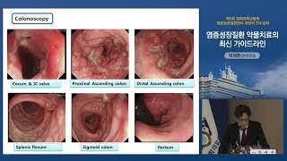 염증성장질환 약물치료의 최신 가이드라인 - 강남세브란스병원 소화기내과 박재준 교수