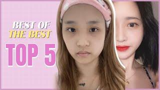 Unbelievable Transformation Best 5 in Korean Plastic Surgery Hospital |Before and After with RESULTS