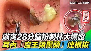 28分鐘激爽片！粉刺林、巨痘大爆發 耳內「魔王級黑頭」連根拔起｜@setn