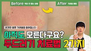 두드러기(가려움증) 원인과 치료법 공개. 이 2가지 무조건 해야 좋아집니다.