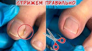 Ingrown toenails / Nail prone to ingrowth