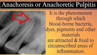 Anachoresis | Anachoretic Pulpitis | RJ Dental World | Dr. Jyoti Agarwal