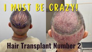 Transplant Surgery # 2 in Bangkok at Hairtran Clinic. A step by step look at the procedure