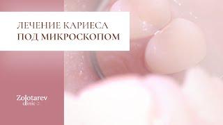 Как лечится кариес под микроскопом?