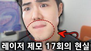 수염 레이저 제모 17회차 후기 (아포지엘리트 이거 맞아...?)