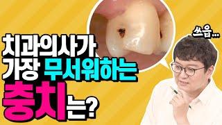 [납량특집] 치아사이 충치는 일단 대공사!! | 인접면충치 무서운 이유 알려드립니다!