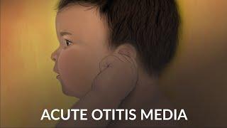 Acute Otitis Media by A. Ruan, J. Cheng | OPENPediatrics