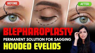 Hooded sagging eyelids upper blepharoplasty | Eyelid lift blepharoplasty | Eye | Dr Anamika Joshi