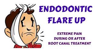 Endodontic Flare Up & Management - Extreme pain & swelling during & after root canal treatment(RCT)