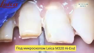 Estetic Dent. Москва. Классическое препарирование под винир под микроскопом Leica М320 Hi-End