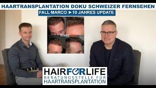 Hair Transplant documentary Switzerland TV - Marco from Germany ► 10 year update and consultation!