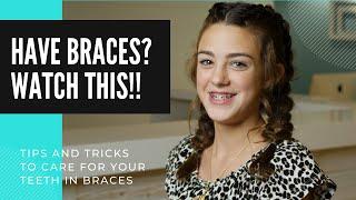 How To Brush and Care for Your Teeth with Damon® Braces at Rucker Ortho