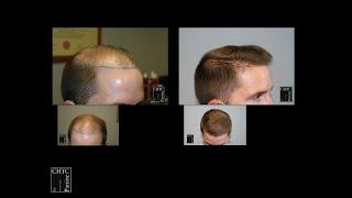 Before and After Photos of FUE Hair Transplant with 2,603 Grafts at CHICAGO HAIR TRANSPLANT CLINIC