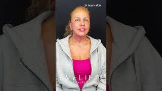 24 Hour EVE Lift™ Result | Eden Plastic Surgery: Dr. Ali Charafeddine, MD