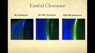 Scleral Lens Fitting Basics May 13, 2015