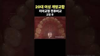 20대 여성 개방교합 치아교정 전후비교