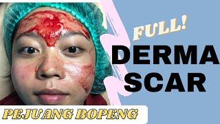 FULL PROSES DERMASCAR | Treatment Bopeng