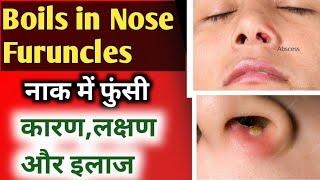 Epi 2 | Boils in nose treatment in hindi/नाक में फुंसी/Causes, symptoms/naak me funsi ka ilaj |