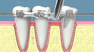 Spostamento ortodontico del dente