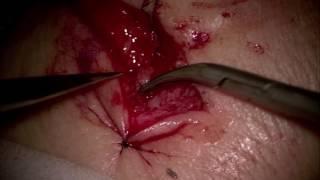 End-to-end  LVA with invagination technique for reconstruction of secondary arm lymphedema – Video