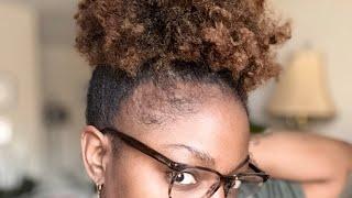 Organic natural products, Natural hair for itchy scalp, Natural hair updo style. #hair #haircare