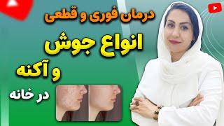 پوست شیشه ای و شفاف با این روش! | درمان انواع جوش صورت و بدن، آکنه و لکه های پوستی