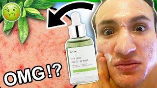 I tried iUNIK Tea Tree Relief Serum for ONE WEEK! || Review (best serum for acne and redness?)