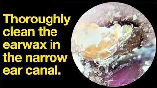 Thoroughly clean the earwax in the narrow ear canal.|ear wax removal | ear cleaning | ASMR |