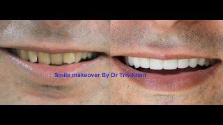 smile makeovers by dr trivikram