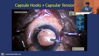 AIOS2025 IC323 T Dr  Raksheeth Nathan Rajagopal Top pearls for Zonulopathy in cataract